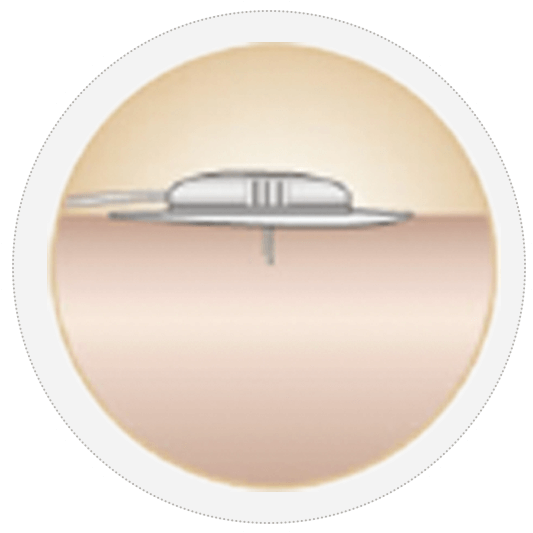 優(yōu)泵儲(chǔ)藥器導(dǎo)管套裝 優(yōu)泵儲(chǔ)藥器導(dǎo)管套裝