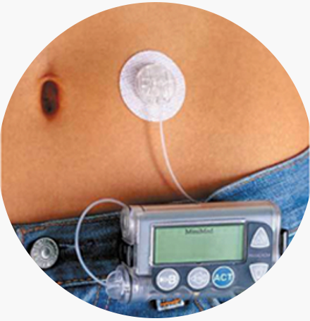 美敦力712胰島素泵